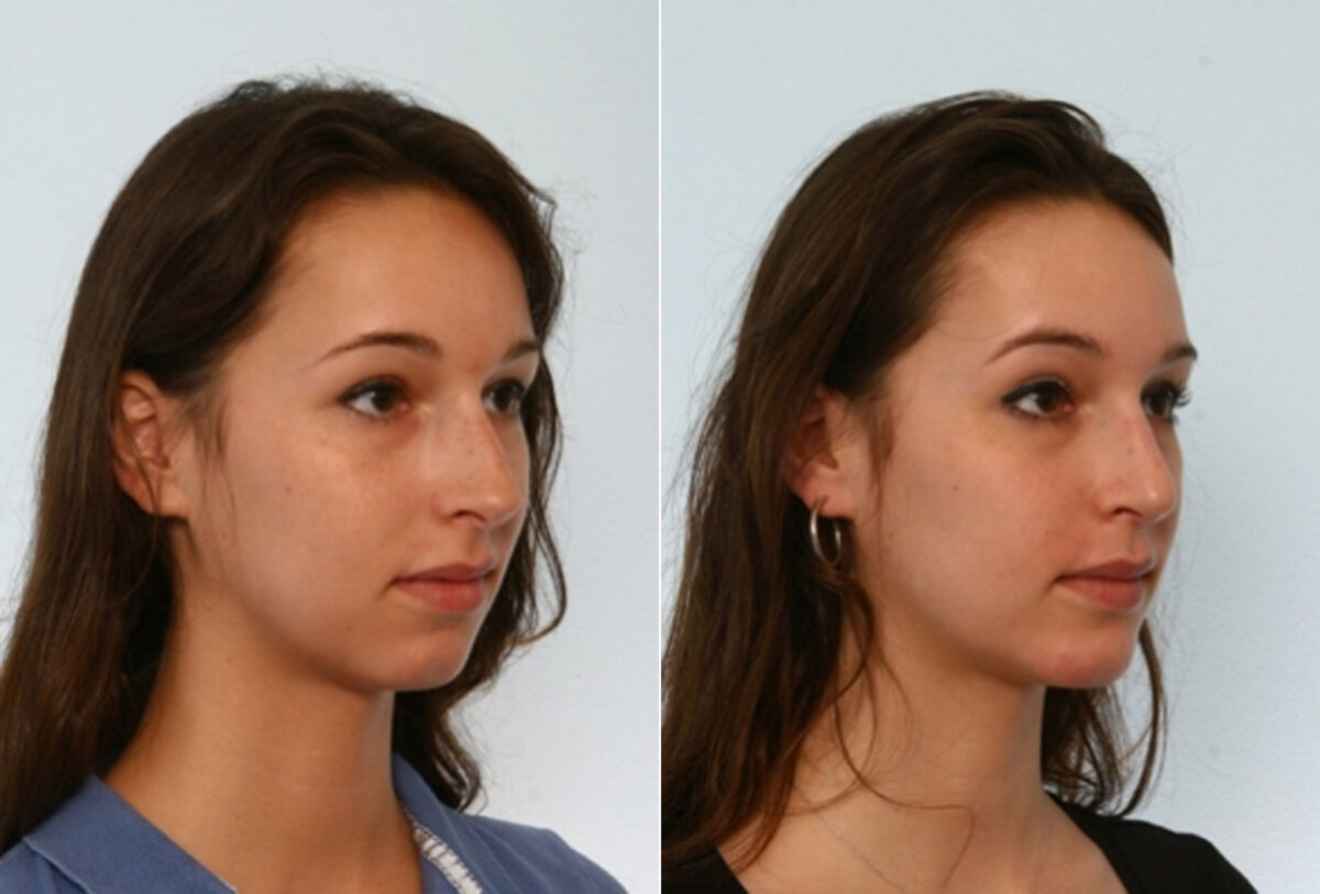 Rhinoplasty before and after photos in Houston, TX, Patient 29490