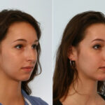 Rhinoplasty before and after photos in Houston, TX, Patient 29490