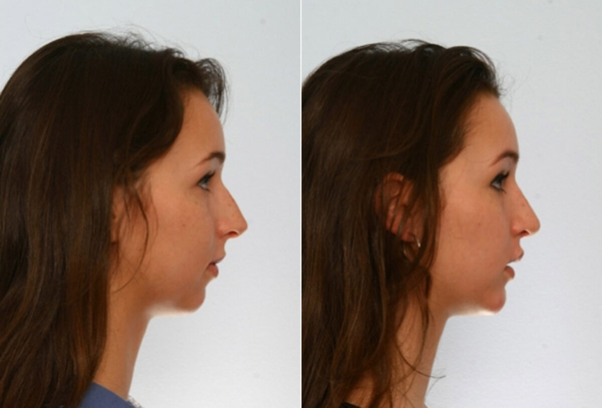 Rhinoplasty before and after photos in Houston, TX, Patient 29490