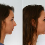 Rhinoplasty before and after photos in Houston, TX, Patient 29490