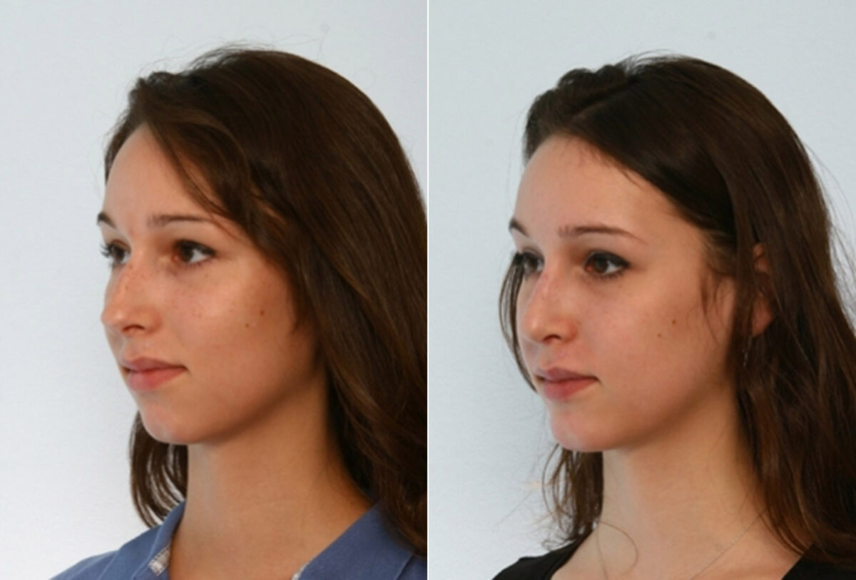 Rhinoplasty before and after photos in Houston, TX, Patient 29490