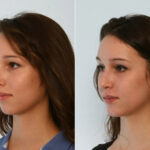 Rhinoplasty before and after photos in Houston, TX, Patient 29490