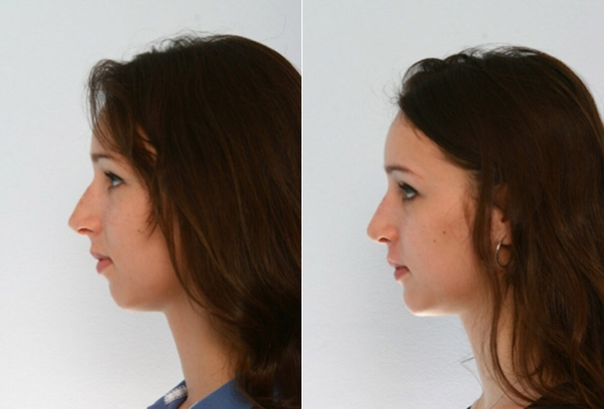 Rhinoplasty before and after photos in Houston, TX, Patient 29490