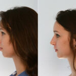 Rhinoplasty before and after photos in Houston, TX, Patient 29490