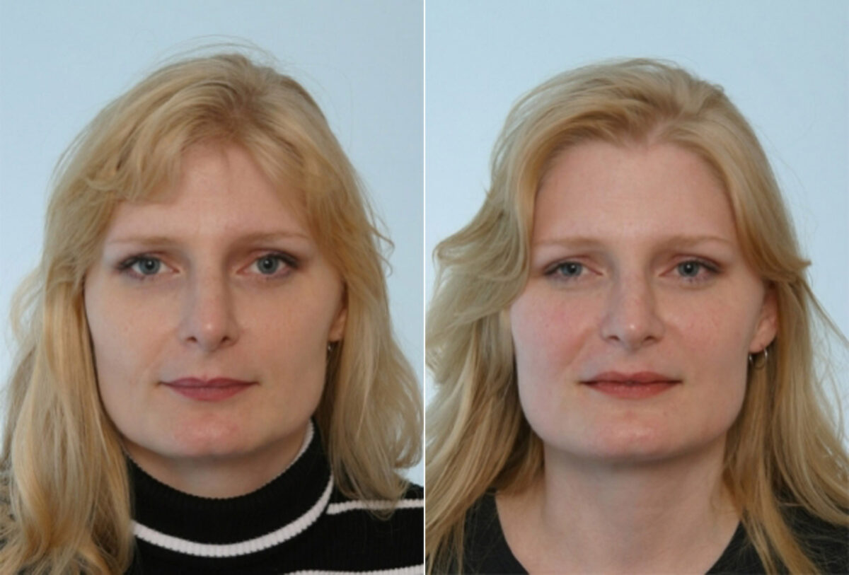 Rhinoplasty before and after photos in Houston, TX, Patient 29501