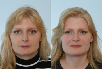 Rhinoplasty before and after photos in Houston, TX, Patient 29501