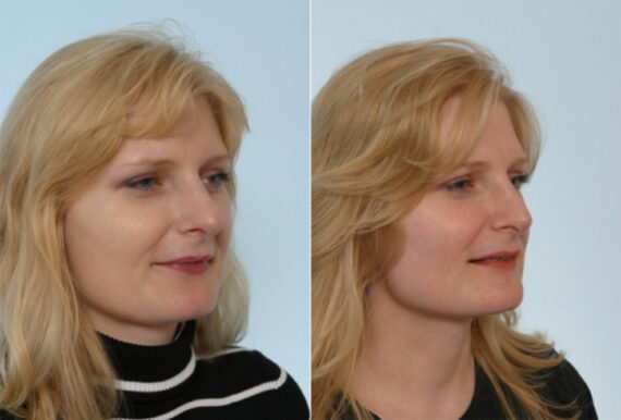 Rhinoplasty before and after photos in Houston, TX, Patient 29501