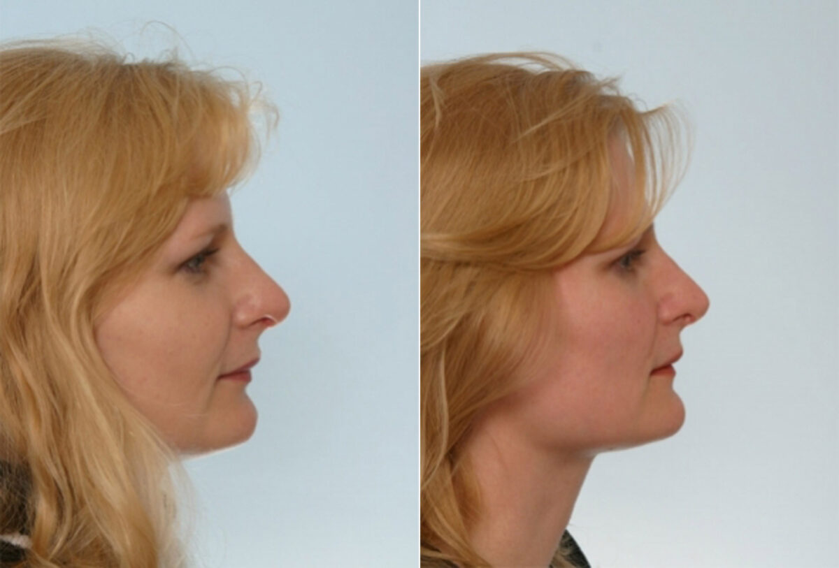 Rhinoplasty before and after photos in Houston, TX, Patient 29501