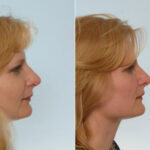 Rhinoplasty before and after photos in Houston, TX, Patient 29501
