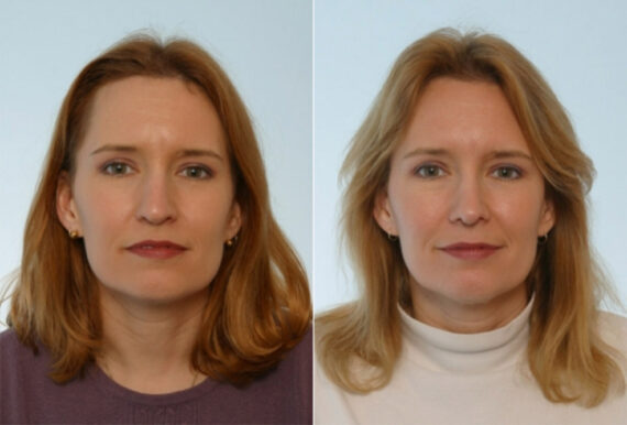 Rhinoplasty before and after photos in Houston, TX, Patient 29508