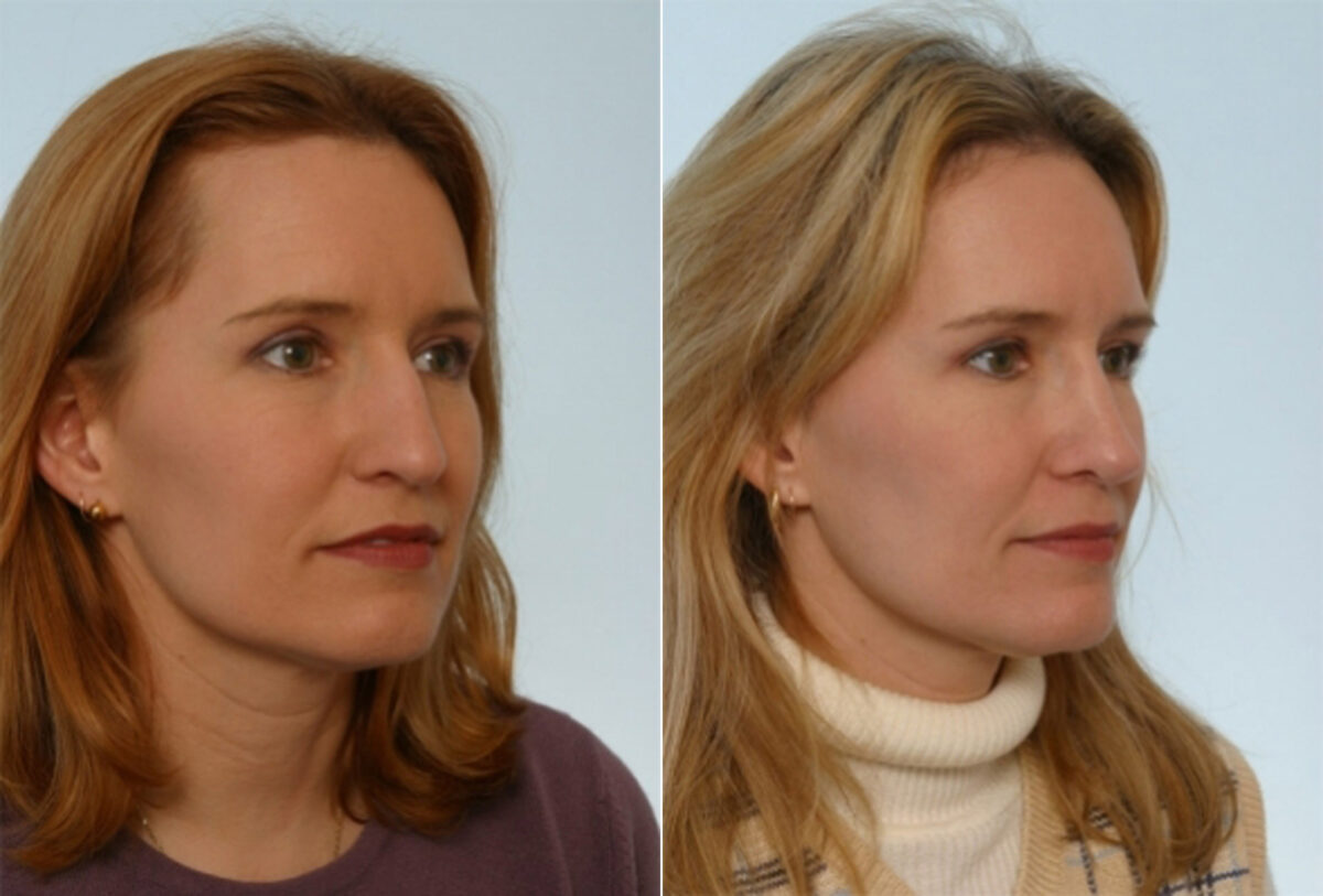 Rhinoplasty before and after photos in Houston, TX, Patient 29508