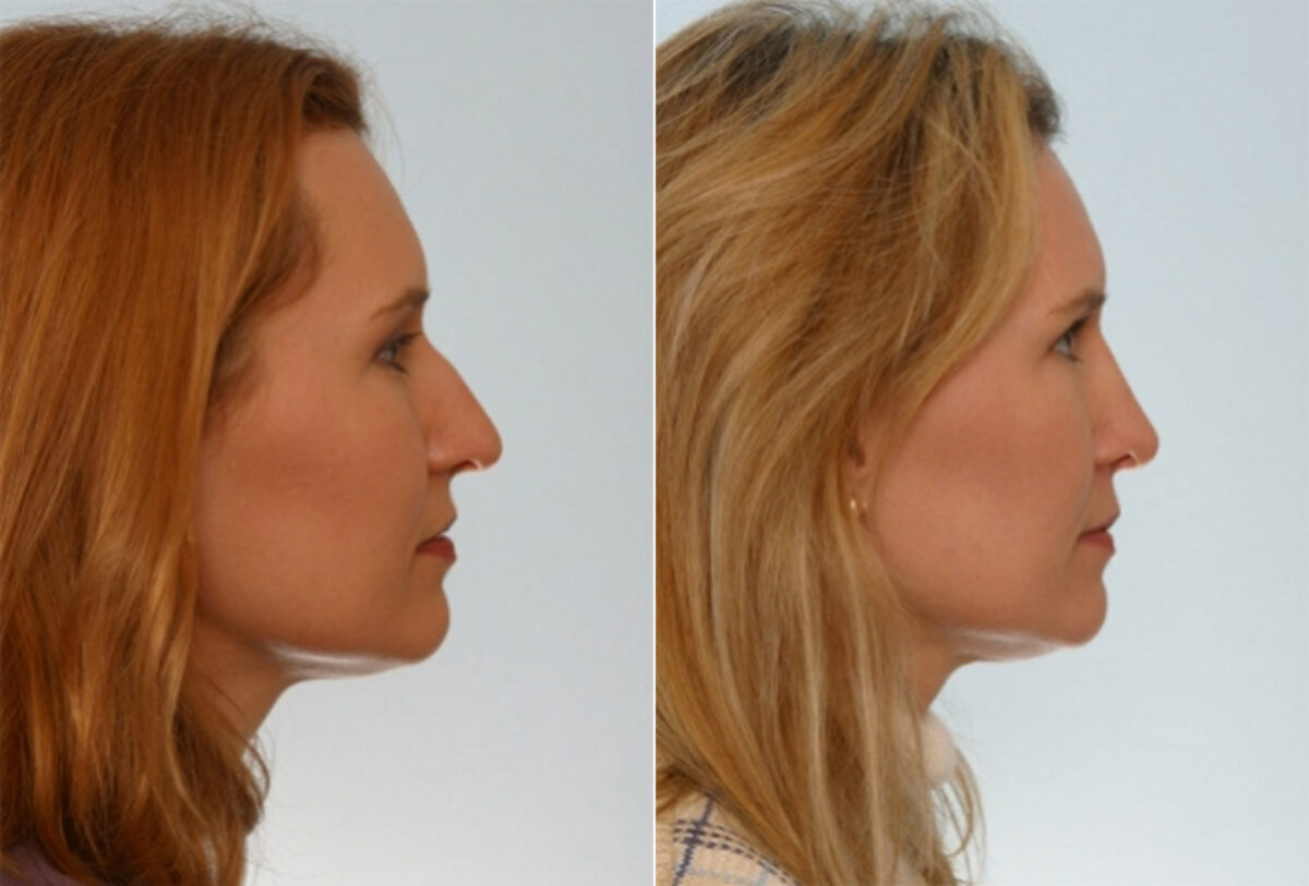 Rhinoplasty before and after photos in Houston, TX, Patient 29508