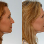 Rhinoplasty before and after photos in Houston, TX, Patient 29508
