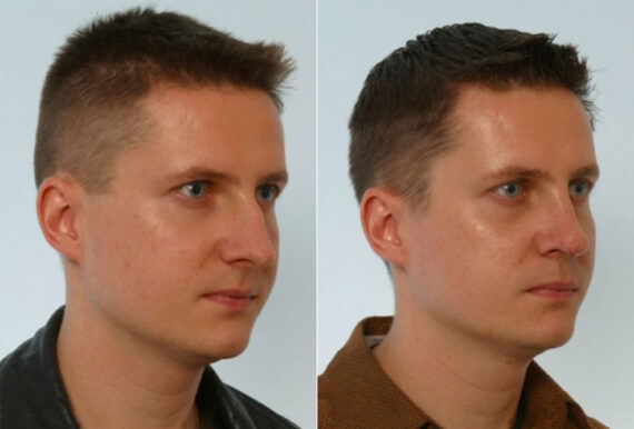 Rhinoplasty before and after photos in Houston, TX, Patient 29515