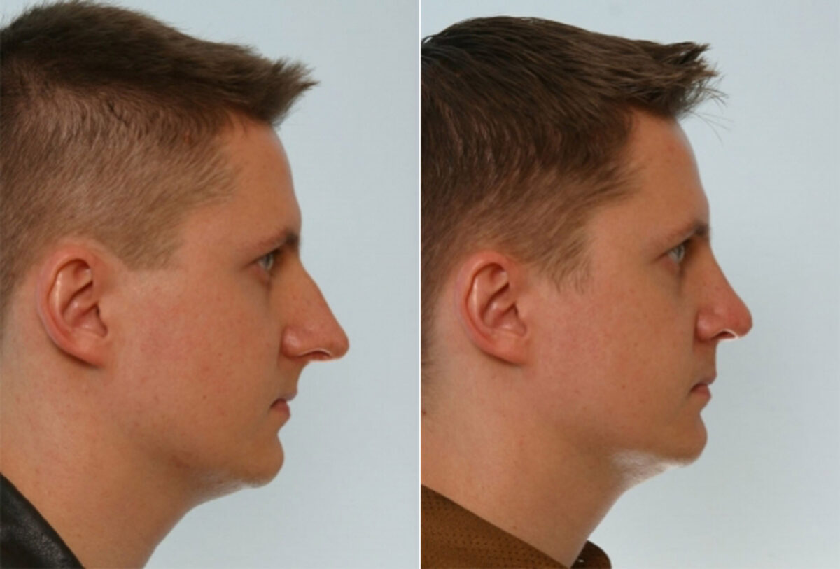 Rhinoplasty before and after photos in Houston, TX, Patient 29515