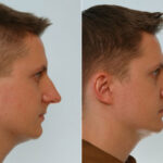 Rhinoplasty before and after photos in Houston, TX, Patient 29515