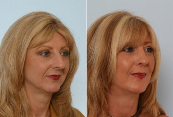 Rhinoplasty before and after photos in Houston, TX, Patient 29522