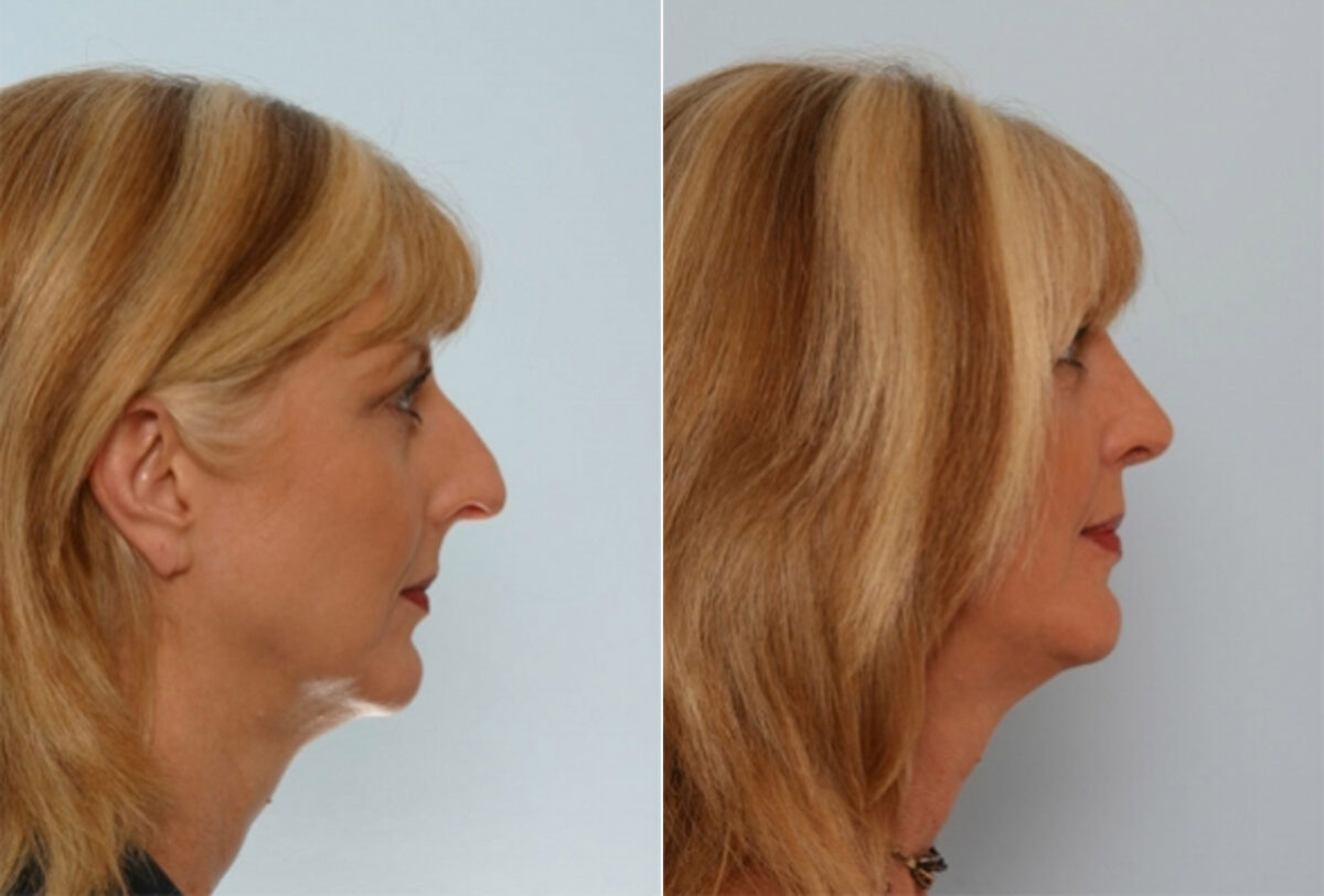 Rhinoplasty before and after photos in Houston, TX, Patient 29522