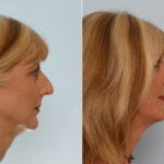 Rhinoplasty before and after photos in Houston, TX, Patient 29522