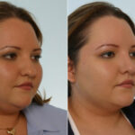 Rhinoplasty before and after photos in Houston, TX, Patient 29529