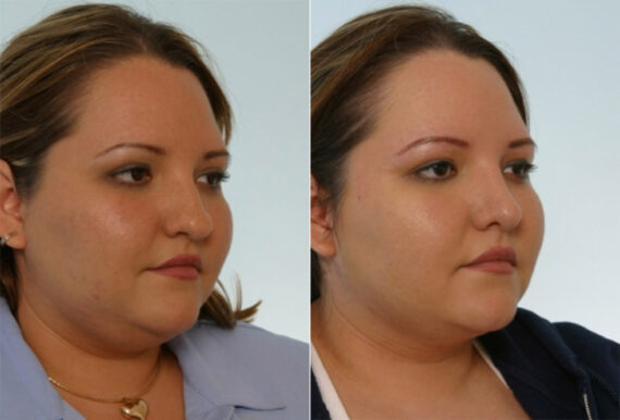 Rhinoplasty before and after photos in Houston, TX, Patient 29529