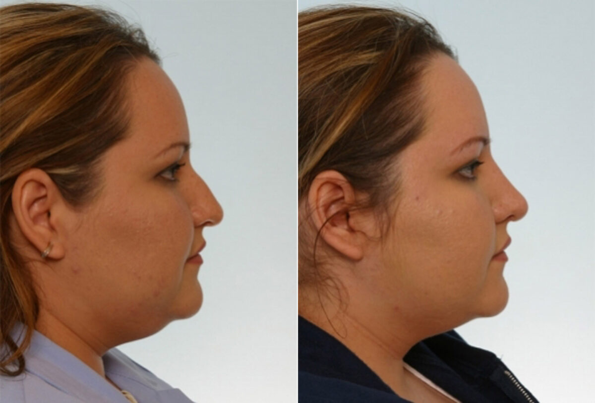 Rhinoplasty before and after photos in Houston, TX, Patient 29529