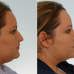 Rhinoplasty before and after photos in Houston, TX, Patient 29529