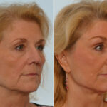 Rhinoplasty before and after photos in Houston, TX, Patient 29536