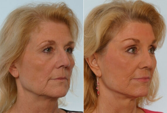 Rhinoplasty before and after photos in Houston, TX, Patient 29536