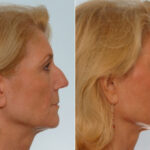 Rhinoplasty before and after photos in Houston, TX, Patient 29536