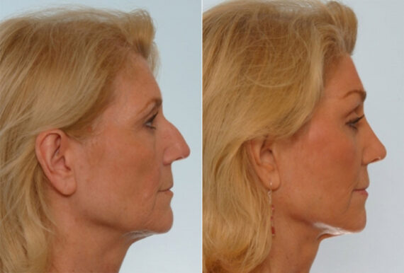 Rhinoplasty before and after photos in Houston, TX, Patient 29536