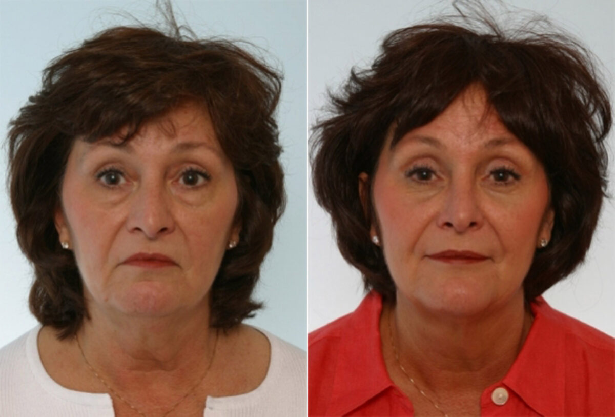 Rhinoplasty before and after photos in Houston, TX, Patient 29543