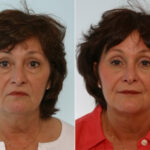 Rhinoplasty before and after photos in Houston, TX, Patient 29543