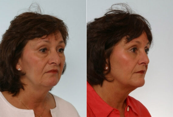 Rhinoplasty before and after photos in Houston, TX, Patient 29543