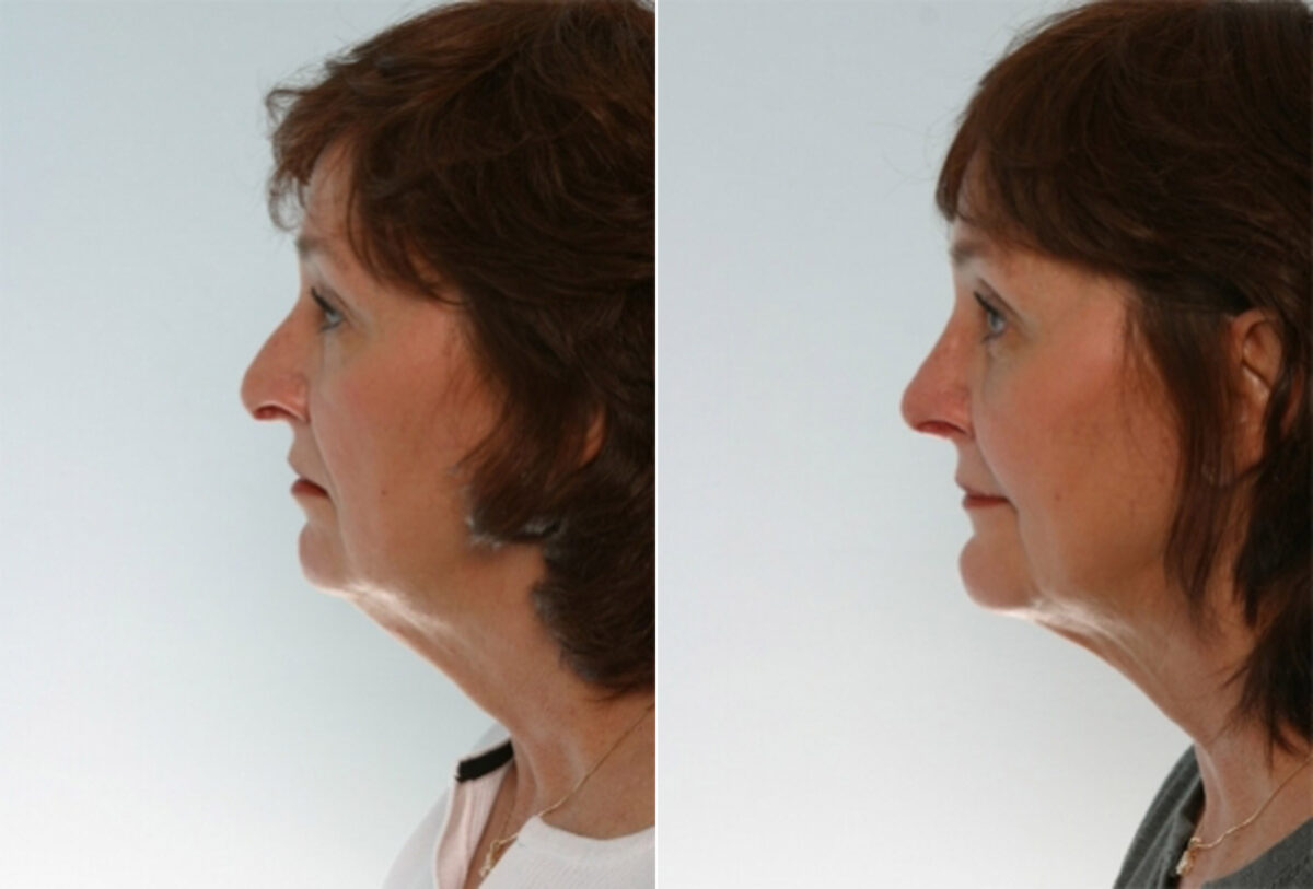 Rhinoplasty before and after photos in Houston, TX, Patient 29543