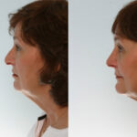 Rhinoplasty before and after photos in Houston, TX, Patient 29543