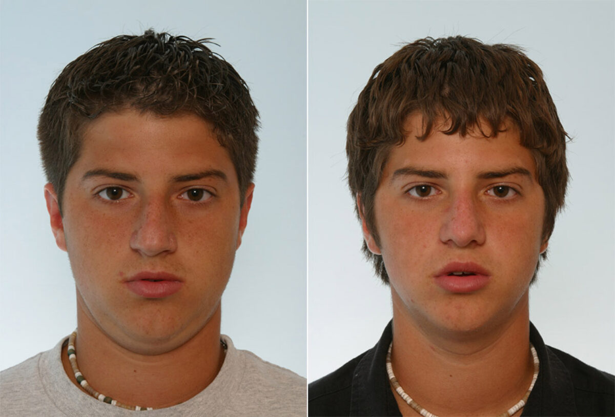 Patient 29557, Rhinoplasty before and after photos Rhinoplasty before and after photos in Houston, TX, Patient 29557