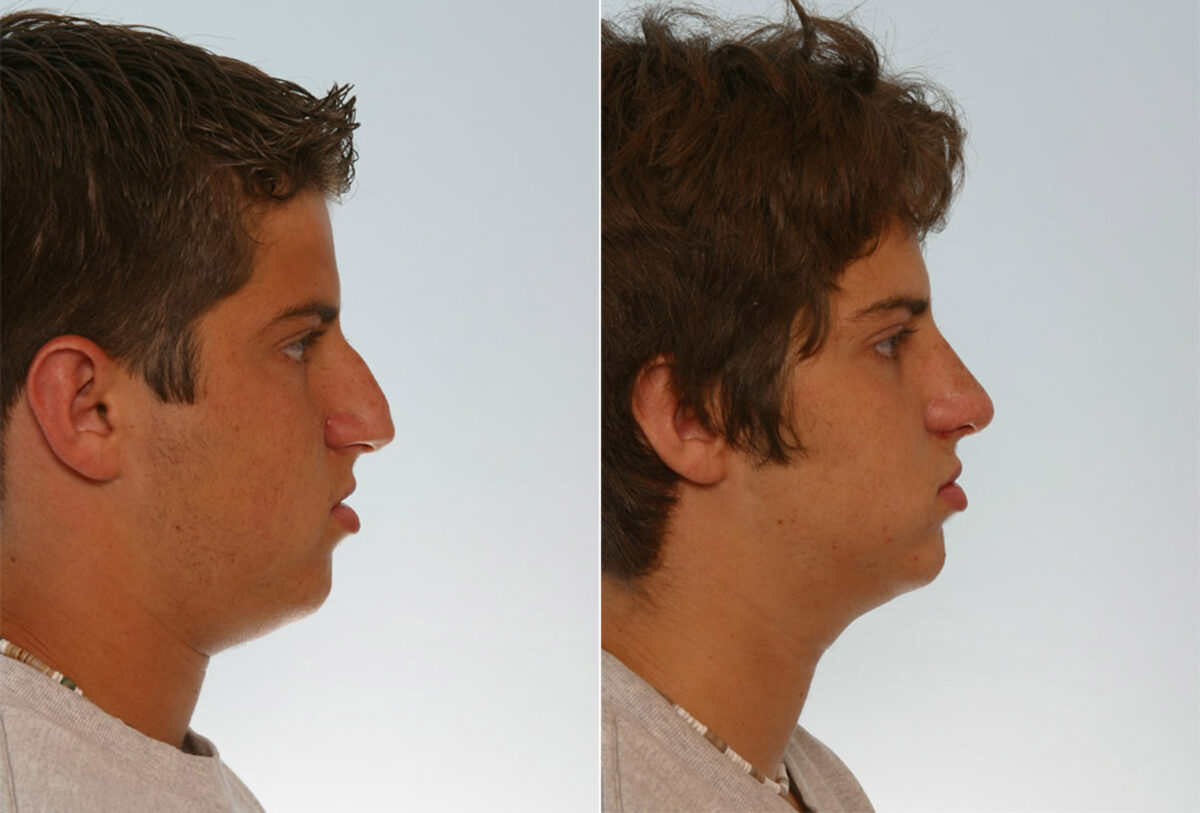 Rhinoplasty before and after photos in Houston, TX, Patient 29557