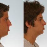 Rhinoplasty before and after photos in Houston, TX, Patient 29557