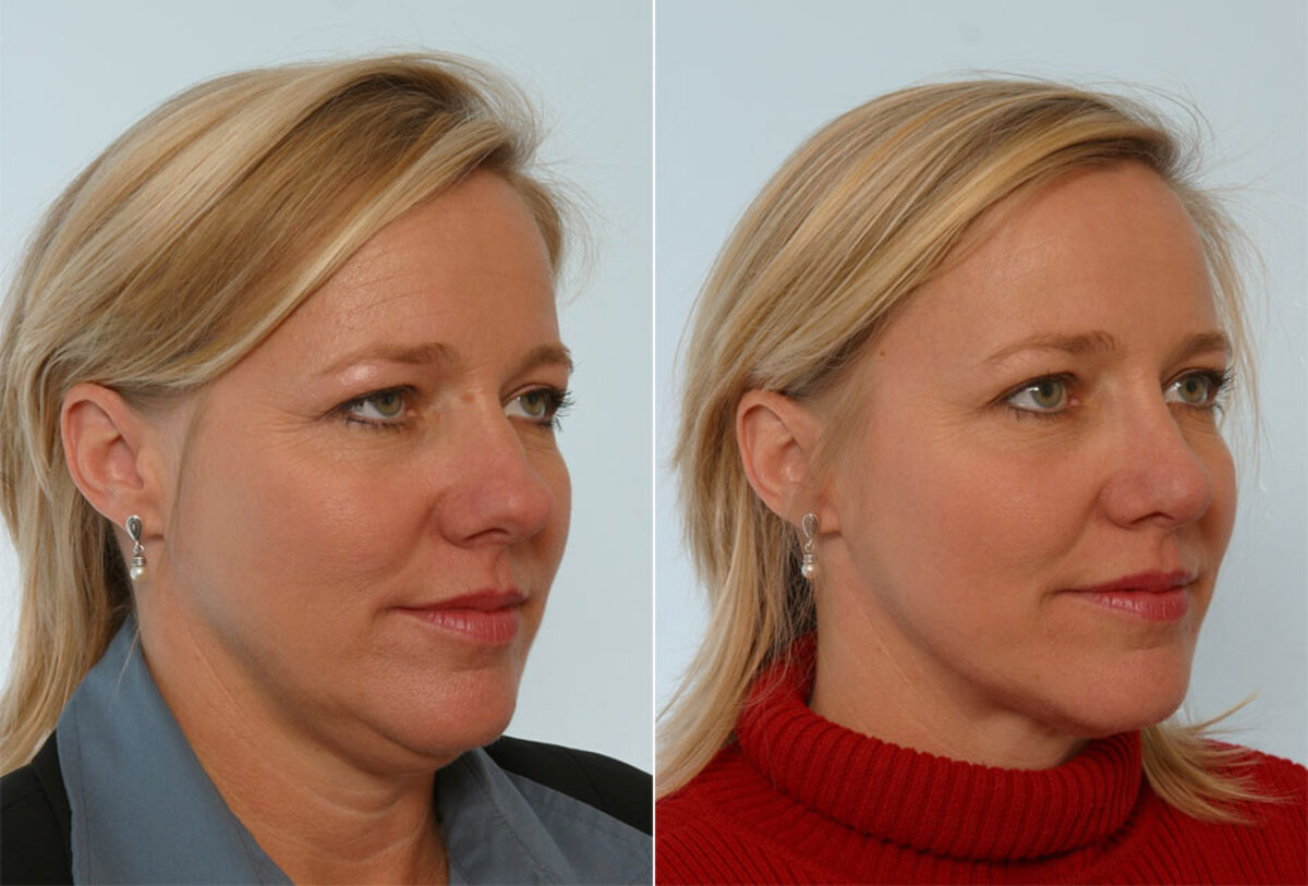 Rhinoplasty before and after photos in Houston, TX, Patient 29564