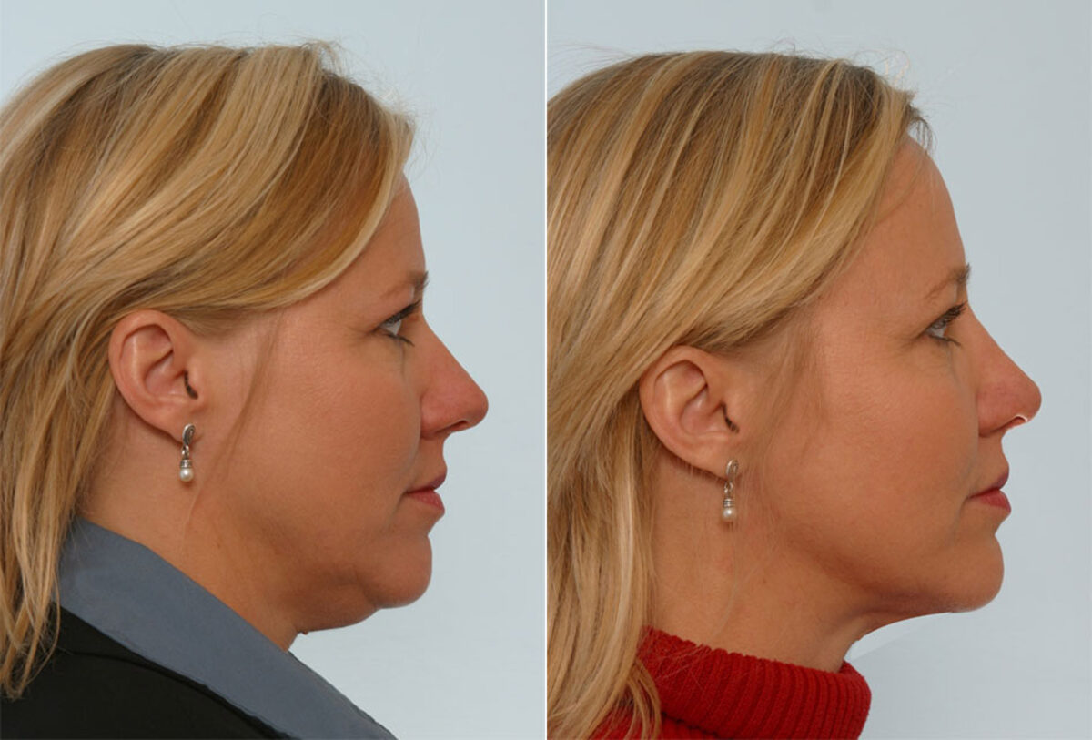 Rhinoplasty before and after photos in Houston, TX, Patient 29564