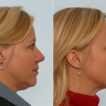 Rhinoplasty before and after photos in Houston, TX, Patient 29564