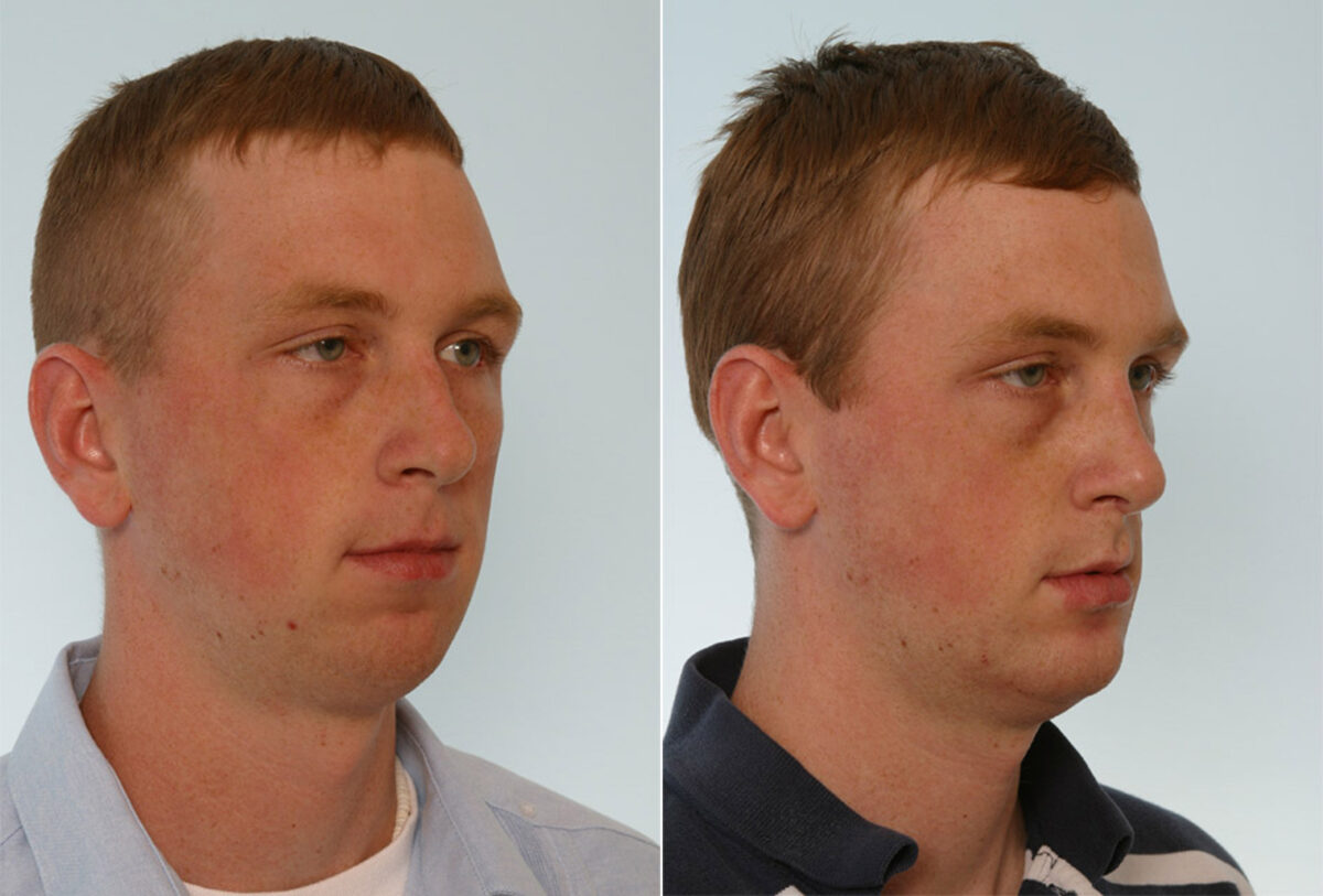 Rhinoplasty before and after photos in Houston, TX, Patient 29571