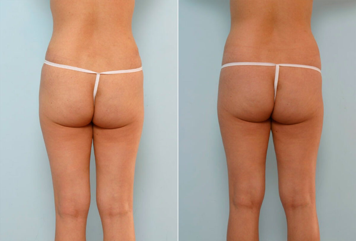 Tummy Tuck/Abdominoplasty before and after photos in Houston, TX, Patient 24243