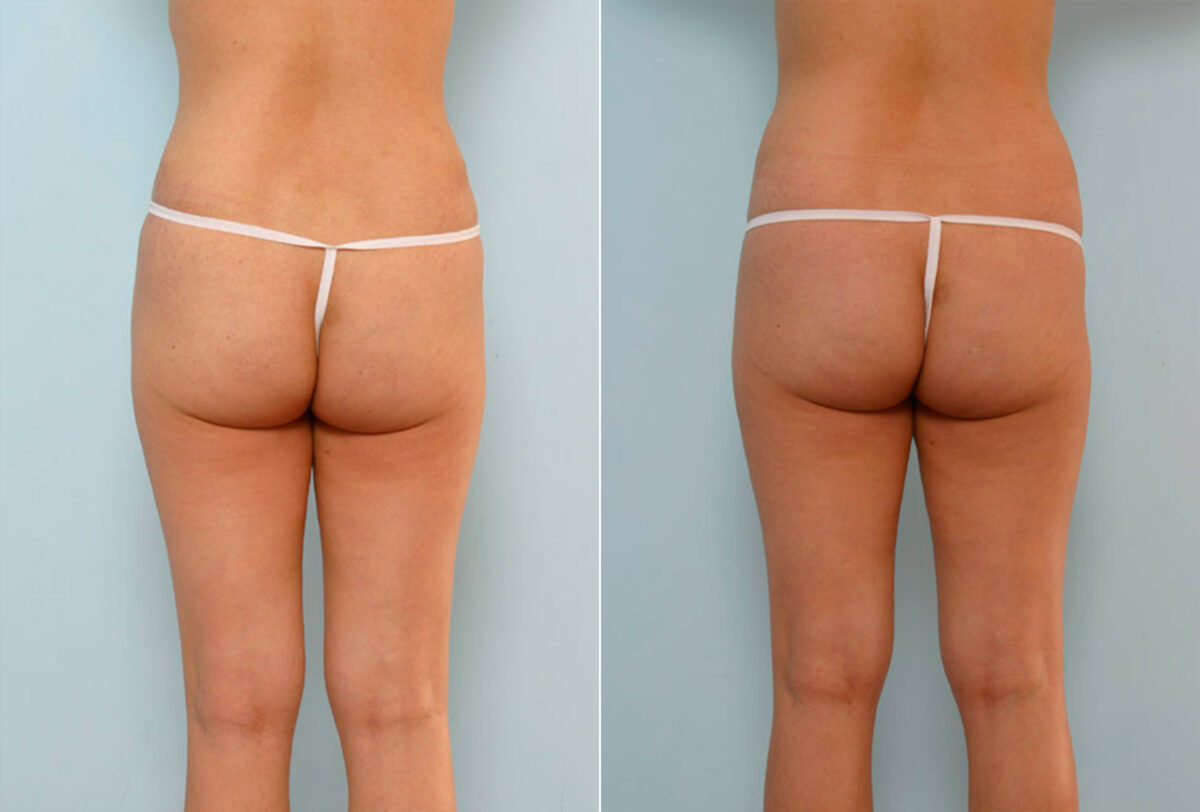 Abdominoplasty before and after photos in Houston, TX, Patient 24243