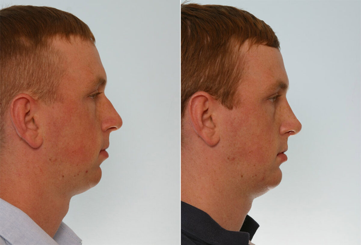 Rhinoplasty before and after photos in Houston, TX, Patient 29571