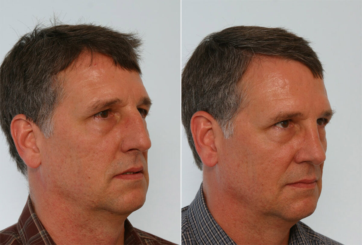 Rhinoplasty before and after photos in Houston, TX, Patient 29576