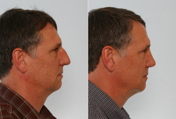 Rhinoplasty before and after photos in Houston, TX, Patient 29576
