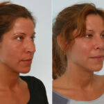 Rhinoplasty before and after photos in Houston, TX, Patient 29583