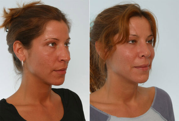 Rhinoplasty before and after photos in Houston, TX, Patient 29583